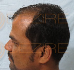 hair regrowth products in india