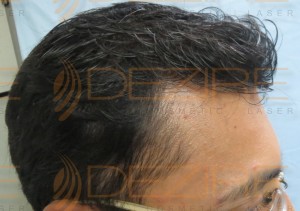 hair replacement in Delhi