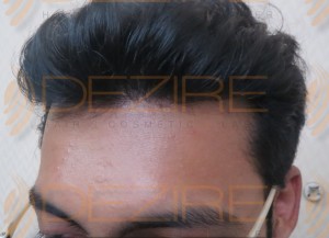hair replacement in india