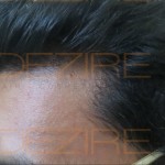 hair replacement reviews