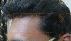 hair replacement reviews