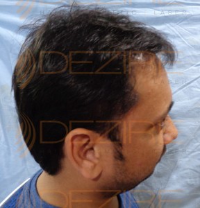 hair replacement systems cost