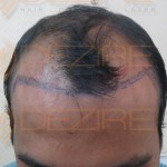 hair restoration latest technology
