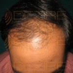 hair restoration low cost