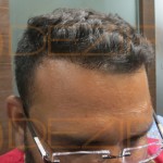 hair surgery in India