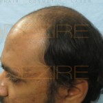 hair thinning at crown male