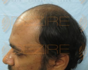 hair thinning at crown male