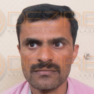 hair transplant 2500 grafts before and after