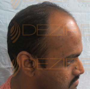 hair transplant before after india