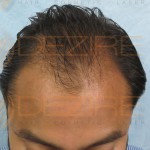 hair transplant before and after 1500 grafts
