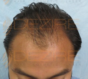 hair transplant before and after 1500 grafts