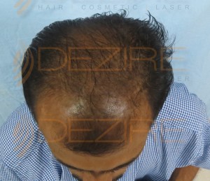hair transplant before and after 2000 grafts