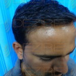 hair transplant before and after 3000 grafts