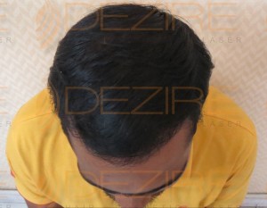 hair transplant before and after Images