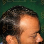 hair transplant benefits and side effects