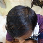 hair transplant best results in india