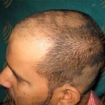 hair transplant clinic pune pune, maharashtra 411036
