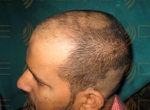 hair transplant clinic pune pune, maharashtra 411036