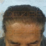 hair transplant cost india in world
