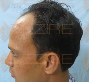 hair transplant donor area