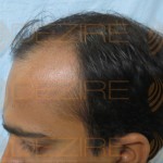 hair transplant grafts falling out