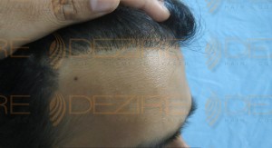 hair transplant growth stages