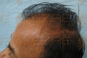 hair transplant in pune cost