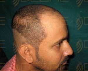 hair transplant in pune low cost