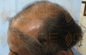 hair transplant in pune low cost