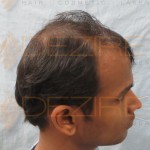 hair transplant is successful or not