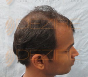 hair transplant is successful or not