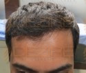 hair transplant near me cost - Hair Transplant Pune