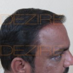 hair transplant options in india