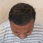 hair transplant pictures after 3 months