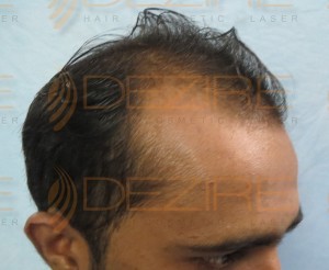 hair transplant pictures after 3 months