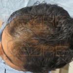 hair transplant prp treatment