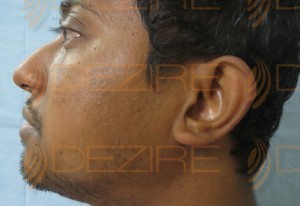 hair transplant recovery pictures