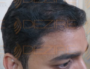 hair transplant success rate in india