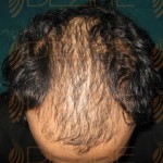 hair transplant success rate india