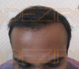 hair transplant surgery after