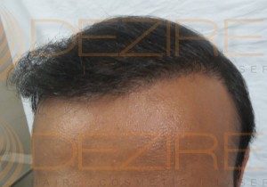 hair transplant surgery how much cost