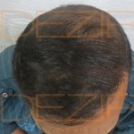 hair transplant surgery how rupees