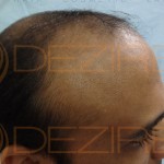 hair transplant surgery pictures