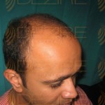 hair transplant surgery price in india