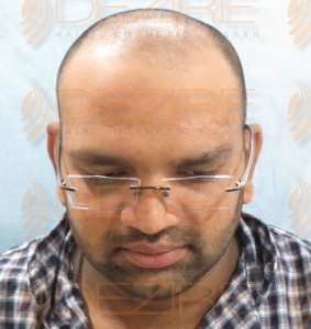 hair transplant surgery safe or not