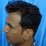 hair transplantation cost in indian rupees