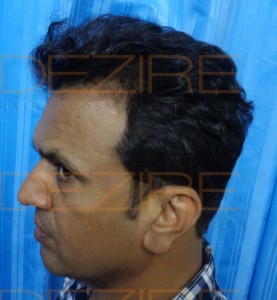 hair transplantation cost in indian rupees