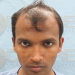 hair transplants gone wrong pictures