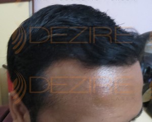 how long does it take for a hair transplant scar to heal