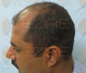 how many prp required after hair transplant